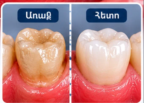 Կերամիկական ատամնապսակ